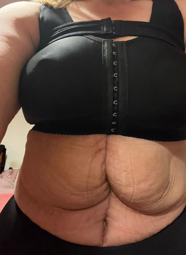 Witney says the swelling has not subsided more than four mo<em></em>nths after the procedure and she's been left 