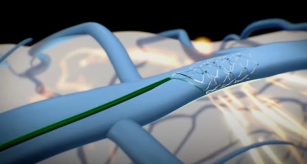 Synchron’s BCI was implanted in a blood vessel on the “surface of the motor cortex of the brain via the jugular vein,” which the company said was a “minimally-invasive endovascular procedure.”