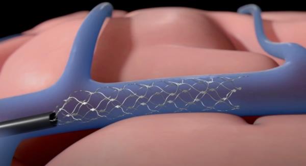 Since implanting the device -- which did not require open brain surgery -- Mark has become the first human to use his thoughts to co<em></em>ntrol an Amazon Fire tablet. 